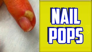 Top 4 Paronychia amp Nail Infections of All Time [upl. by Airbmac]