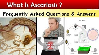 What is Ascariasis   Ascaris Lumbricoids Infections  FAQ [upl. by Martin]