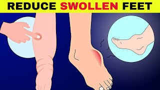 6 Natural Ways To Reduce Swollen Feet amp Ankle FAST That Actually Work [upl. by Nina]