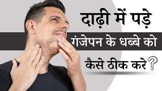 दाढ़ी में पड़े गंजेपन के धब्बे को कैसे ठीक करे  Alopecia Areata Beard  Alopecia Areata Treatment [upl. by Arraic]