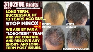 3102Grafts Long term 13ys1HT Telogen effluvium due to MINOXIDIL Sorted out in 4 months3452010 [upl. by Inaboy]