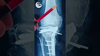 Intraarticular osteotomy [upl. by Tayyebeb175]