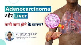 Adenocarcinoma और Liver पानी जमा होने के कारण  Fluid Buildup in the Liver  Dr Praveen Kammar [upl. by Sternlight]