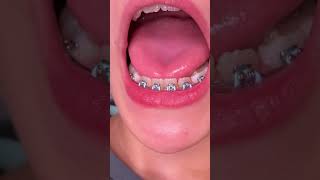 What is Phase One orthodontic treatment  Tooth Time Family Dentistry New Braunfels [upl. by Gena639]