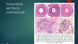 Alopecia Dermpath Lecture ft Dr Niedt [upl. by Jard897]