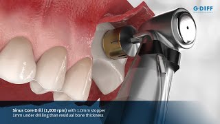 GDIFF Dental implant system  Sinus Elevation ProcedureLateral Approach [upl. by Dahsraf]