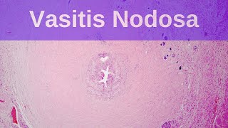 Vasitis Nodosa  Pathology mini tutorial [upl. by Eixid]