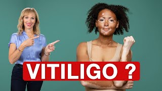 WHAT Causes VITILIGO  Dr Janine [upl. by Viv]