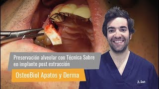 Preservación alveolar con Técnica de Sobre  Dr Carlos Escuer [upl. by Bennion588]