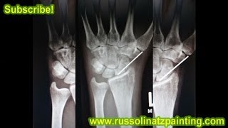 Scaphoid Nonunion Proximal pole fracture Xray Bone Graft with pin fixation  long arm plaster cast [upl. by Alphonse501]