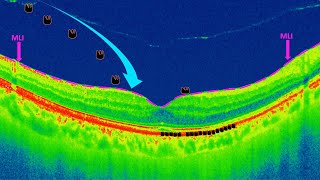 Estructura de la Membrana Epirretiniana [upl. by Ailla248]