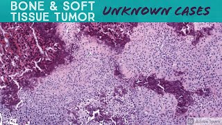 Soft Tissue amp Bone Tumor Pathology Unknown Cases Yale see video description for digital slides [upl. by O'Grady]