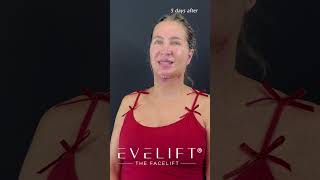 EVE Lift™ Patient Before and 5 Days After  Eden Plastic Surgery Dr Ali Charafeddine MD [upl. by Dart]