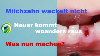 Der Milchzahn wackelt nicht und der nächste bleibende Zahn kommt woanders raus [upl. by Uon]