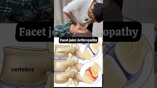 Facet joint arthropathy treatment feed ytshort trend [upl. by Ahsekim]