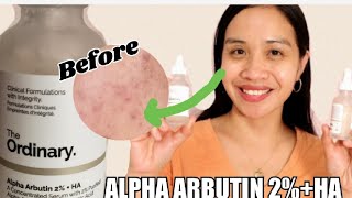 THE ORDINARY ALPHA ARBUTIN 2  HA TO REMOVE PIMPLE SCAR REMOVE SKIN DISCOLORATION [upl. by Eseilanna]