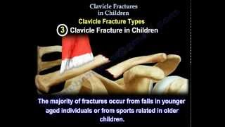 Clavicle Fractures In Children  dont worry the outcome is usually good [upl. by Frederick]