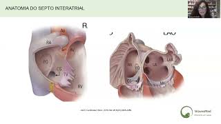 Aula completa Punção transseptal Wavesmed [upl. by Ritz]