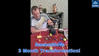 SaeboGlove Before and After  Look at the Transformation [upl. by Galven949]