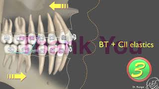 Clinical considerations for Bite turbosBT｜【Chris Chang Ortho】CC486 [upl. by Yelkao857]