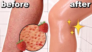 HOW TO GET RID OF STRAWBERRY LEGS IN ONE DAY Get Rid Of Keratosis Pilaris And Dark Spots On Legs [upl. by Chris]