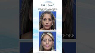 How Deeper Filler Placement can Lift the Face without Surgery nonsurgicalfacelift [upl. by Earahs460]