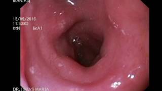 Endoscopie Digestive Haute Upper Gastrointestinal Endoscopy [upl. by Anabal]