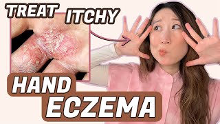 How to Treat Hand Eczema 🖐️ Dr Joyce Dermatologist [upl. by Bilac932]