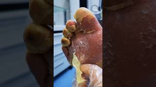 Peel foot skin as if tearing paper satisfying podiatrist podiatry podiatrycare nails [upl. by Ahsiekit]