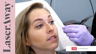 Xeomin Treatment LIVE SESSION at LaserAway 🔴 [upl. by Susan]