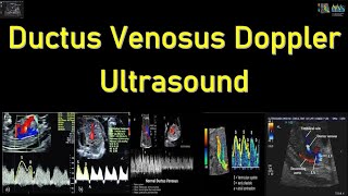 Fetal Ductus Venosus Doppler Ultrasound Interpretation [upl. by Kat]