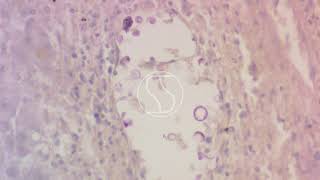 Cryptococcus neoformans under the microscope with Periodic acidSchiff PAS stain [upl. by Seaden304]