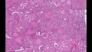 Histopathology KidneyDiabetic glomerulosclerosis [upl. by Ttoille411]