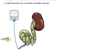 Urosonografia miccional [upl. by Ardnoid]