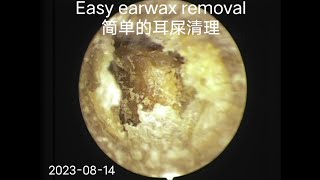 Acute suppurative otitis mediaEarwax removal（急诊化脓性中耳炎耳屎清理）20230814 [upl. by Wilonah]