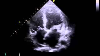 Echogenic focus in left ventricle in the heart at my 18 week ultrasound scan [upl. by Eiramait]