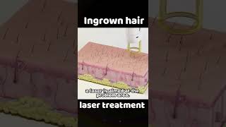 Ingrown Hair laser Treatment [upl. by Malissia98]