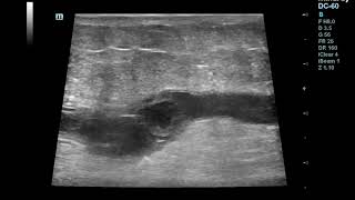 Superficial Thrombophlebitisthrombosis of Great Saphenous Vein [upl. by Agrippina247]