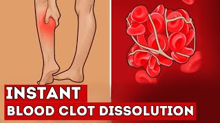 These 7 FOODS Instantly Dissolve Blood Clots in Your Vessels [upl. by Adali]