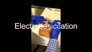 Electrodesiccation and Curettage EDampC  How To [upl. by Skylar]