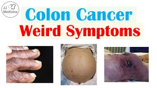 Colon Cancer Weird Symptoms amp Why They Occur [upl. by Areem]