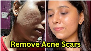 How to remove acne scars 😍  Acne scars remove treatment  My skin transformation journey [upl. by Von]