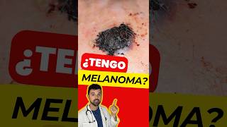 ¿Ese Lunar es un MELANOMA Descubre el ABCDE del Melanoma Maligno [upl. by Nameloc]