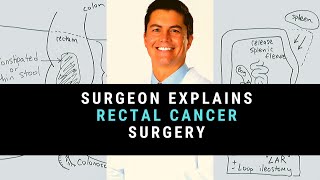 Surgeon Explains Rectal Cancer Surgery [upl. by Kreitman]