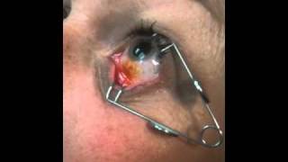 Eye Injection Procedure [upl. by Yenial]