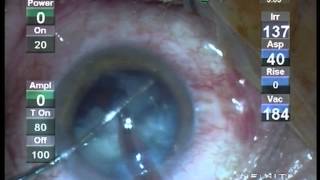 Operatie Cataracta Prof Dr Dorin Chiselita  Clinica Oftaprof [upl. by Almap]