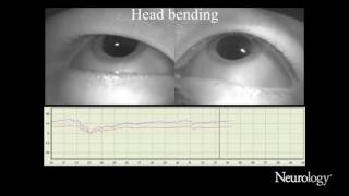 Xlinked adrenoleukodystrophy presenting with positional downbeat nystagmus [upl. by Mulderig]