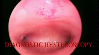 DIAGNOSTIC HYSTEOSCOPY منظار الرحم التشخيصى ED [upl. by Calia632]