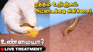 Leech Therapy  அட்டைய கடிக்க விட்டு சிகிச்சையா😱  This is how Leech Therapy Done  Live Treatment [upl. by Harleigh]