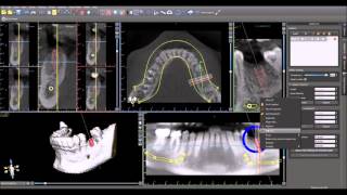 DICOM to Surgical Guide 15 Min [upl. by Lawrence]